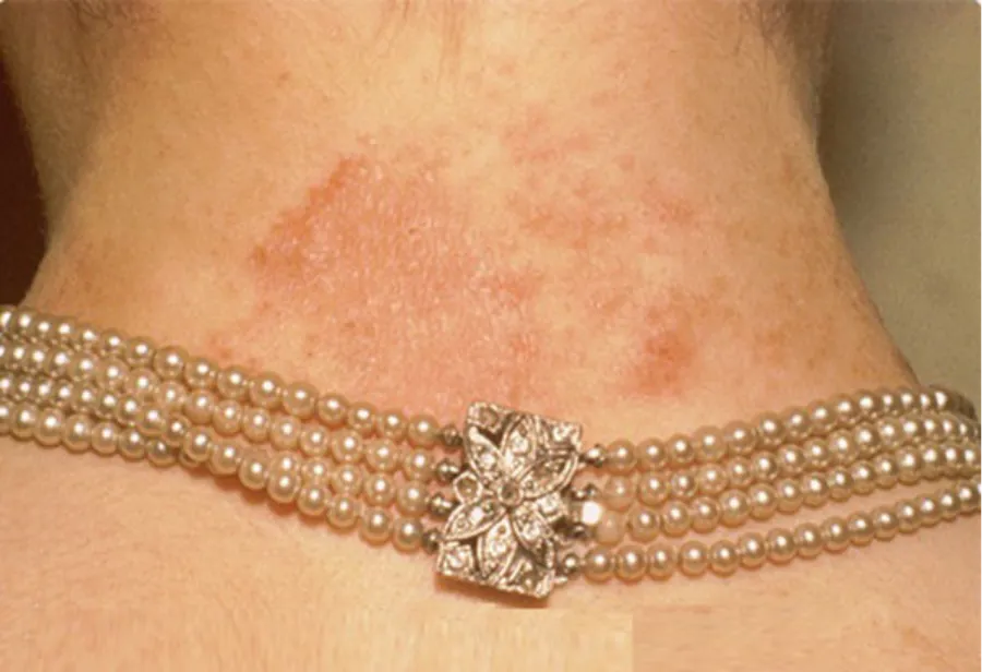 Kim Loại Gây Dị Ứng: Nhận Diện Nickel và An Toàn Trang Sức